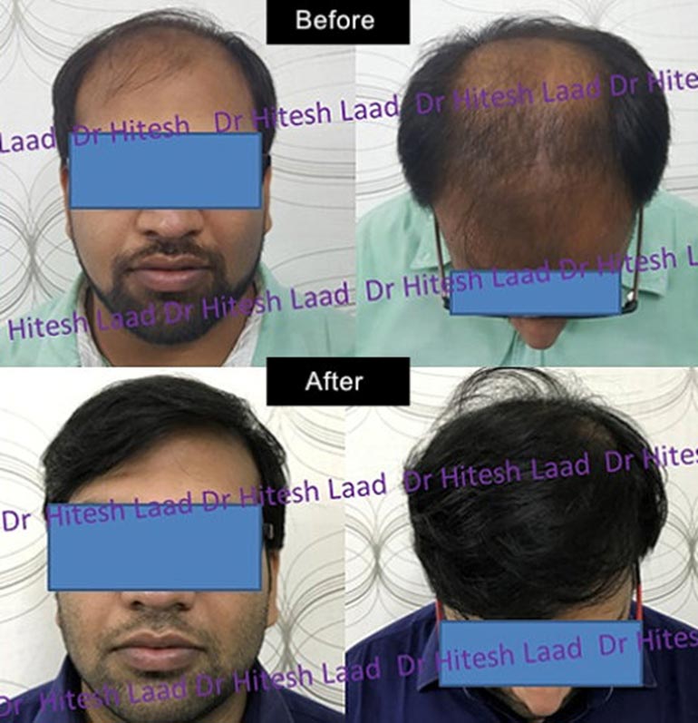 hair transplant case-3